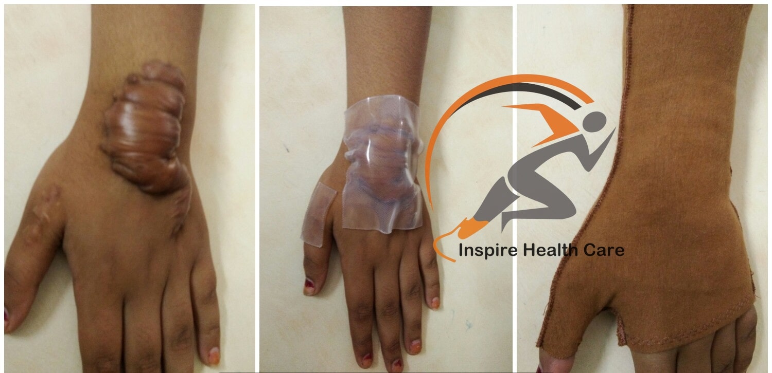 Inspire Structure  Pressure Garments and Silicone Gel Care Sheet<