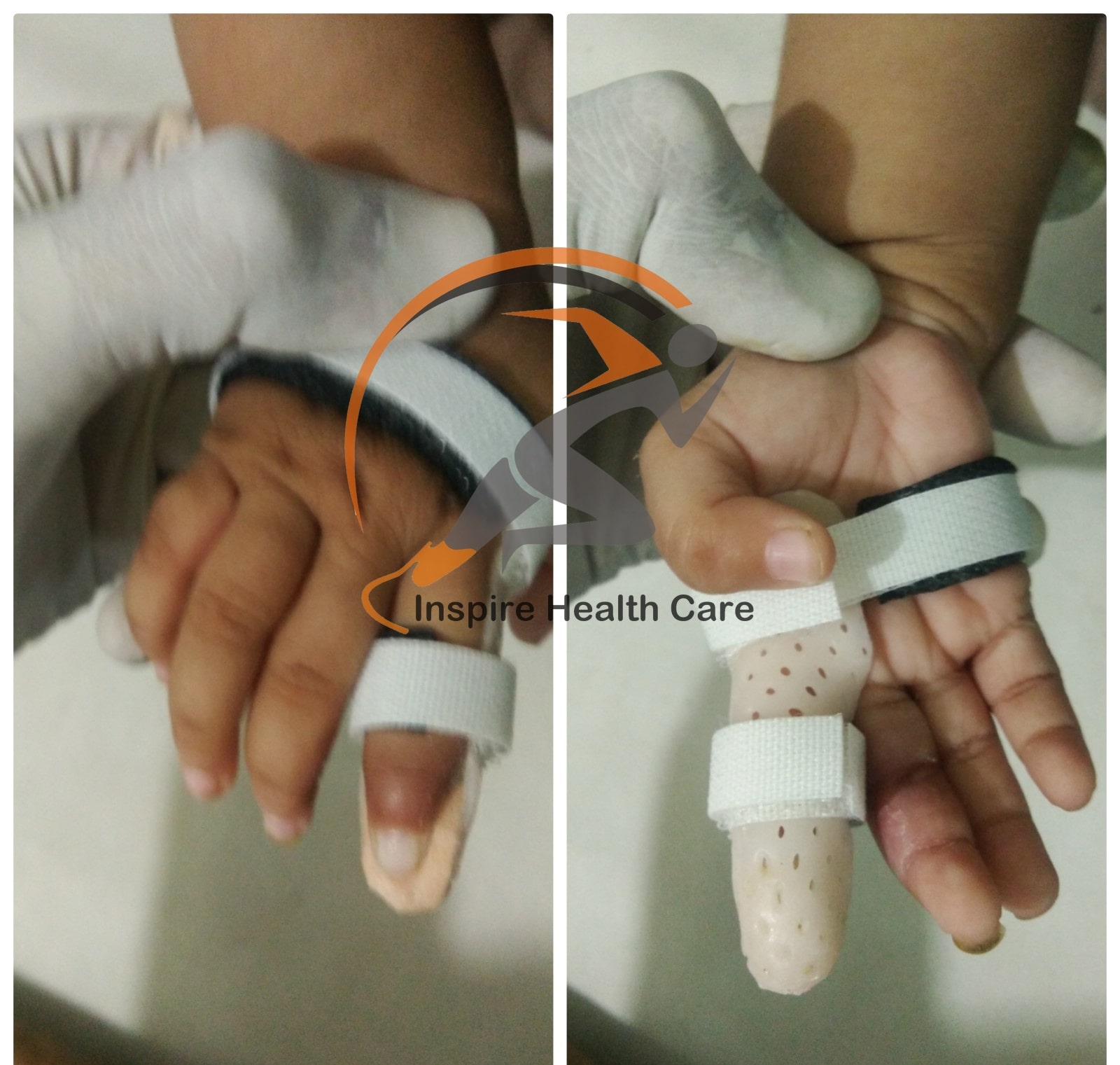 Inspire Structure | Low Temperature Thermo Plastic Splinting