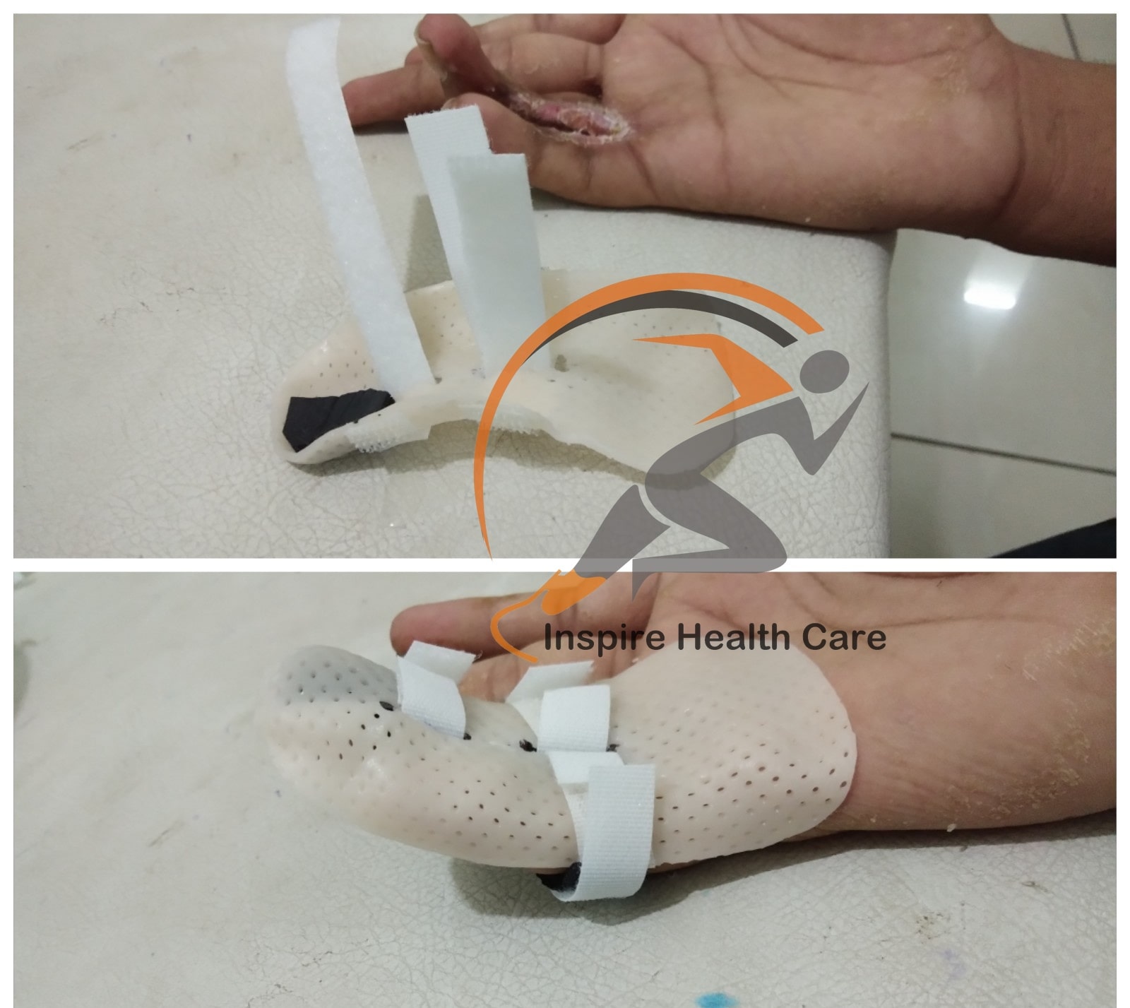 Inspire Structure | Low Temperature Thermo Plastic Splinting